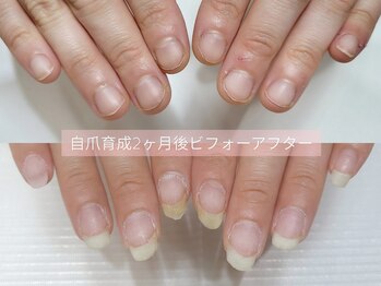 深爪矯正before&after