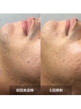 リムル(REMURU)/ひげ脱毛5回照射