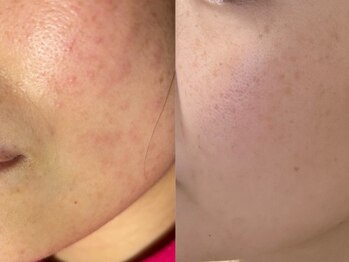 ユウビビューティサロン 東生駒(Yuubi Beauty Salon)/【peel stage】ハーブピーリング