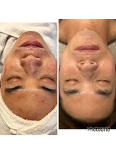 リラベル(Lira Belle)/劇的before/after