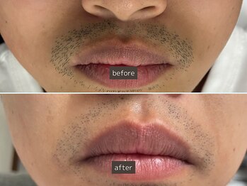 SEC(Shizuoka esthetic company)/【メンズ】脱毛1回