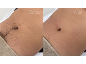 アウラ 表参道(AURA)/ギャランドゥもこの通りツルツル