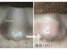 マプン(Mapun)の雰囲気（リンパマッサージに含まれている腸もみは、全身の健康にも◎。）