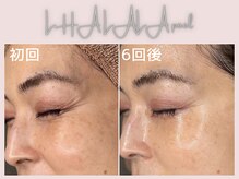 美シェリ(美Cheri)/ララピールビフォーアフター