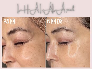 美シェリ(美Cheri)/ララピールビフォーアフター