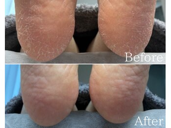 カシェット 広島店(Cachette)/50代女性☆足裏角質ケア90分