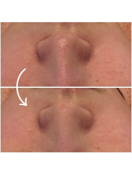 アイリーン(IRENE)/徹底毛穴ケア♪