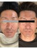 【モニター募集】-5歳若見えメンズ美容!国家資格者によるエステ×小顔整体