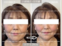 ユウサク(Yusaku)/50代症例【小顔矯正/本町/梅田】