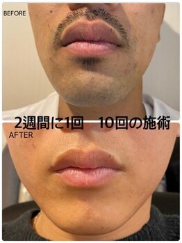 ムーモー 横浜関内店(mu_mo_)/脱毛効果1