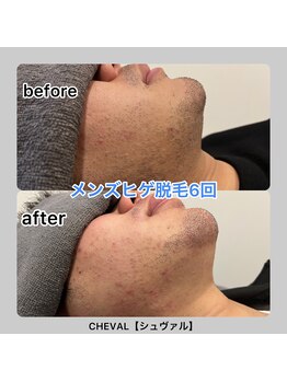 シュバル(CHEVAL)/メンズヒゲ脱毛6回