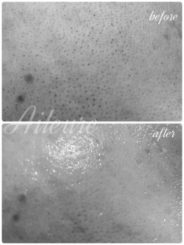 エルール トータルビューティ(Aileure total beauty)/Waxフェイシャル