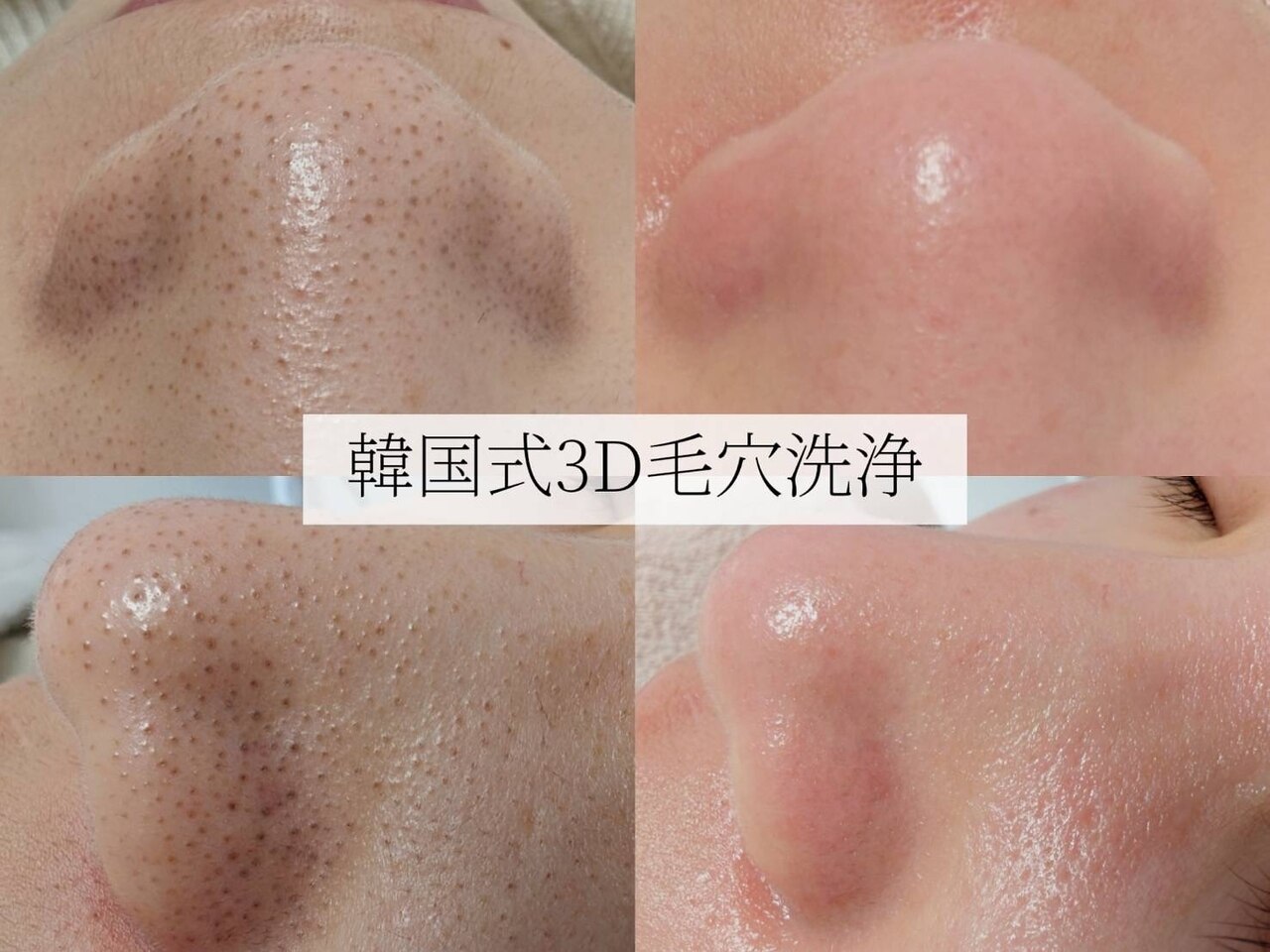 毛穴エステ 込900円 b9fcae30d44cd060443d494ee92c85