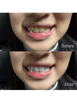 カイリー(KYREE)/WHITENING