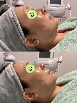 ホワイティアビシェル 浦和(Whitia Vishell)/【フェイシャル】二重あご改善