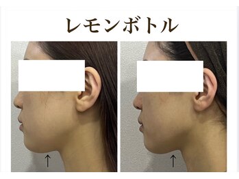 ティアム バイ テトテ 神戸三宮(TIAM by tetote)/レモンボトル