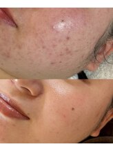 キレナル(KIRENAL)/カーボキシー