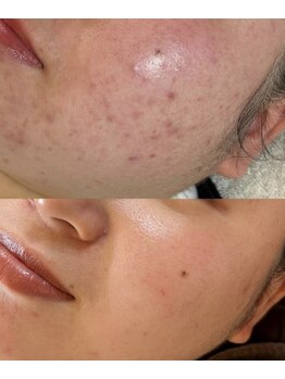 キレナル(KIRENAL)/カーボキシー