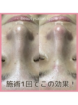 スピカ(Spica)/二刀流毛穴エクストラクション