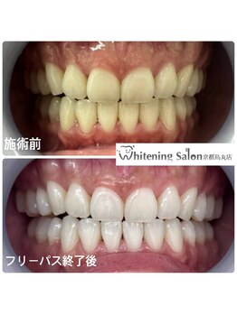 ホワイトニングサロン 京都烏丸店/ホワイトニング施術例