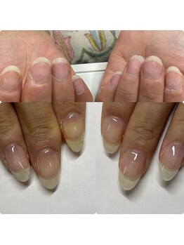 マニュコクーン(ManuCocoon)/爪育成 深爪 巻き爪 大阪市