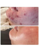 プランス 渋谷(PLANCE)/毛穴/ハーブ/ニキビケア