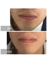 ダンニヒル(dannihil)/【脱毛】20代学生4回目