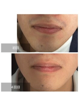 ダンニヒル(dannihil)/【脱毛】20代学生4回目