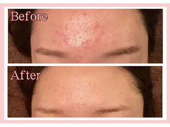 アプリフト(Uplift)/Before★After