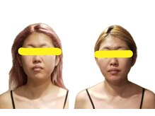 サララ(Salala)/地下鉄赤塚 筋膜小顔矯正 たるみ