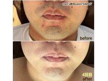 【実際のお客様】青ヒゲが薄くなり、朝髭剃りが楽になったと好評