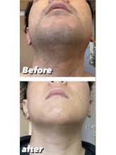 コンフィデンスサロン(Confidence Salon)/メンズ髭脱毛★