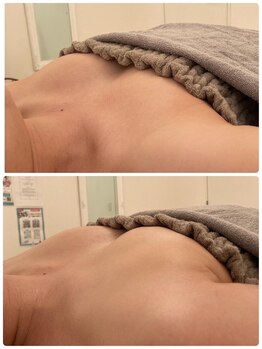 美人バスト 新宿店/☆姉妹店バストアップ症例写真☆