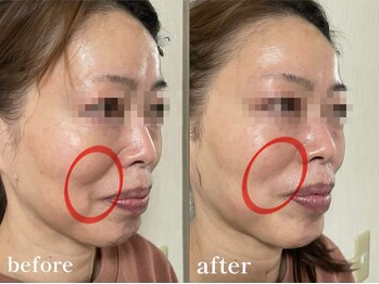 エピリス(Epiliss)/ほうれい線ビフォーアフター