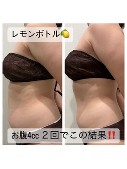 エステティックサロン ラ ベルタ(Esthetic Salon La Belta)/新メニュー♪レモンボトル