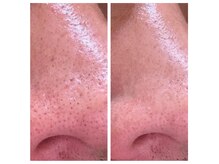 メンズの方も毛穴洗浄で毛穴レスなお肌へ♪