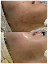 プランス 恵比寿店(PLANCE)/頑固なフェイスラインのニキビ