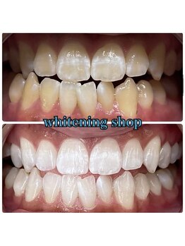 ホワイトニングショップ 池田店/【BEFORE/AFTER】