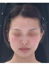 パルティール 恵比寿店(partir)/右頬５分で小顔GET！