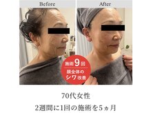 クラティス 伊那店(CRATIS)/エクソソーム導入