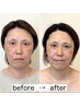 【年齢による面長】間延び顔を立体的に整える小顔矯正90分 初回限定7,900円