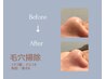 【メンズエステ】×【鼻・毛穴】角栓/吸引/¥4000→