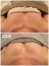 ベルビューティー(belle beauty)/【サイズアップ/C以下】症例写真