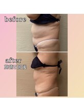 プリマジュール/【圧倒的な効果】サーモシェイプ