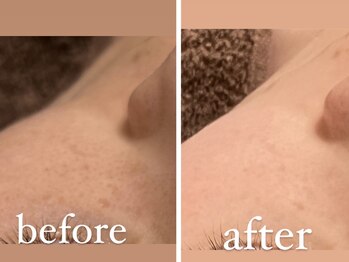 マイア(MYA)/頬くすみビフォーアフター