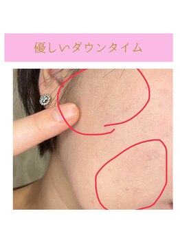 ココロ(COCORO)/剥けるハーブ◇ウンタイム