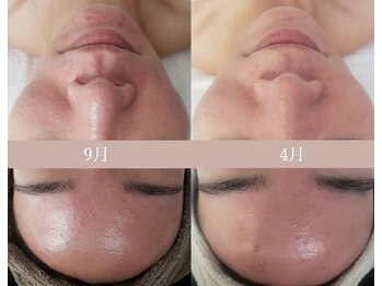 プシュケ(Psyche)/お客様の肌変化