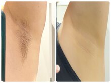 ワイズサロン(Y's salon)/ワキ脱毛１０回したらこうなる♪
