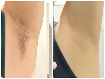 ワイズサロン(Y's salon)/ワキ脱毛１０回したらこうなる♪