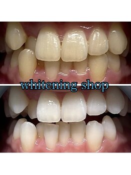 ホワイトニングショップ 池田店/【BEFORE/AFTER】